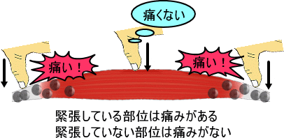 緊張部位の圧痛