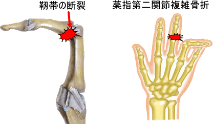 薬指骨折・靭帯断裂
