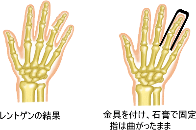 レントゲンと治療方法