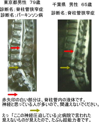 脊柱管狭窄症と診断されたＭＲＩ画像