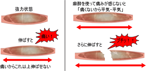 筋肉の緊張の種類 痛みの専門院 東京 日本橋