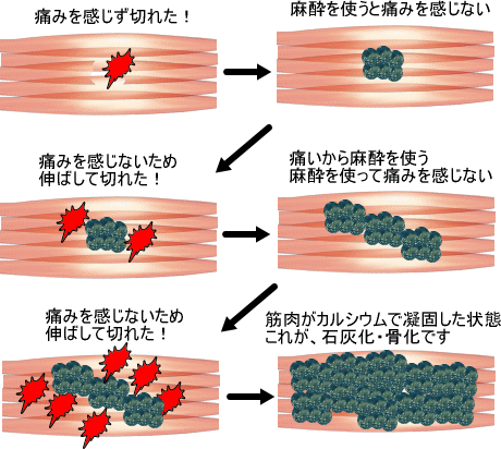 メカニズム 筋肉 痛 筋肉痛について