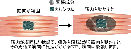 筋肉の緊張の種類 痛みの専門院 東京 日本橋 筋肉の緊張の種類 痛みの専門院 東京 日本橋